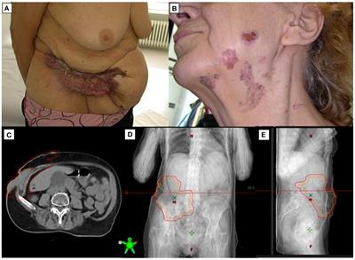 Case report: Sequential treatment strategy for advanced basal cell carcinoma in Gorlin-Goltz syndrome: integration of vismodegib, radiotherapy, surgery, and high-intensity focused ultrasound